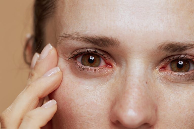 Recognizing Allergic Reactions That Cause Red Eyes Allergic Reactions That Cause Red Eyes