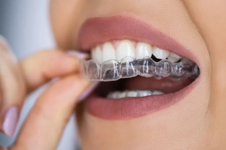 A Closer Look at Clear Braces and Their Benefits and Limitations Closer Look at Clear Braces