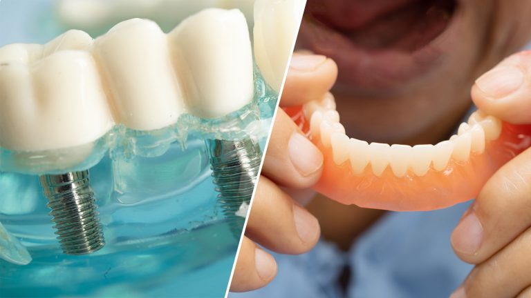 Dental Implants vs Dentures