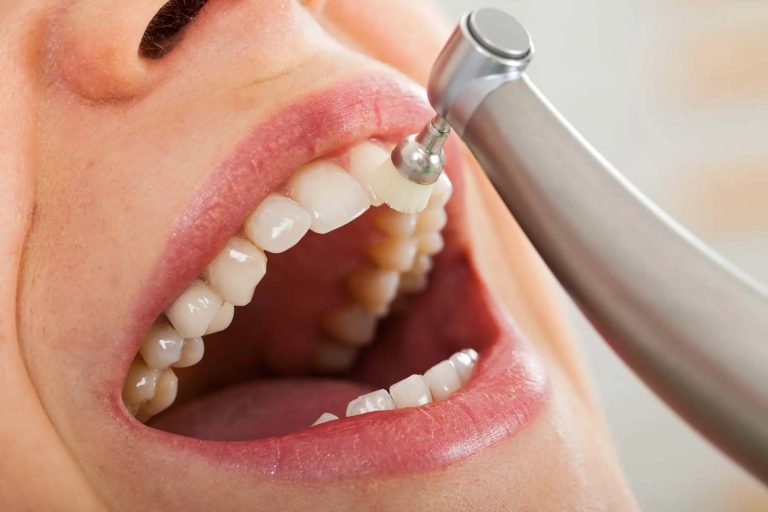 How Professional Teeth Cleaning Improves Oral Health Professional Teeth Cleaning