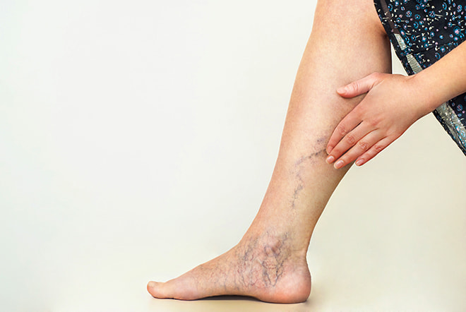Exploring Non-Surgical Options for Varicose Veins Varicose Veins